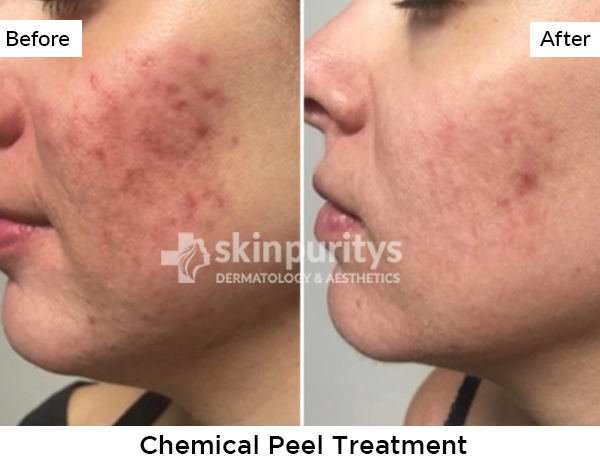 Chemical Peels results